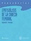 EPIFISIOLISIS DE LA CABEZA FEMORAL